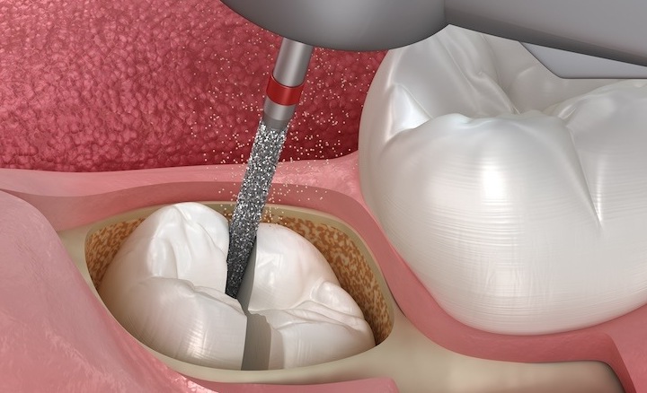 Cerrahi Diş Çekimi